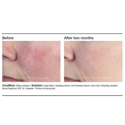 Anti-Redness Serum